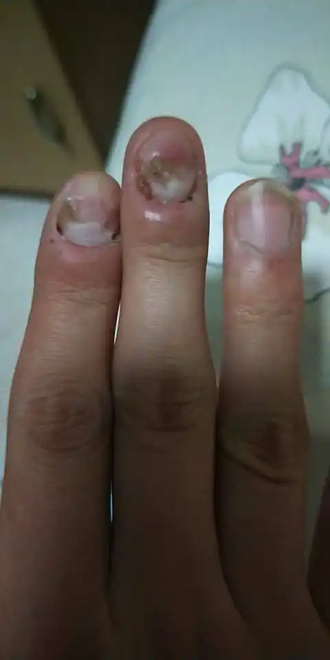 我这个指甲从小咬的.我现在21了不敢出门上班怕别人看到.