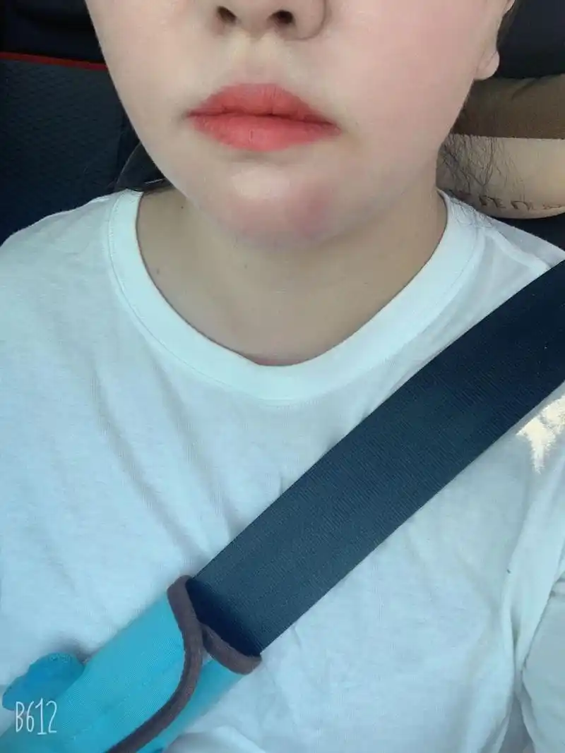 我的下巴一夜之间长了个大火包,又硬又疼