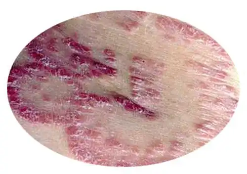 中医通过什么诊断湿疹的状况大晋医匠梁启田