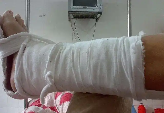 肢体断离伤,常见症状有肢体断离,骨折,出血,不会传染|肿胀|断肢_网易