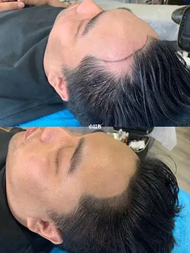哇小哥哥发际线操作前后对比图