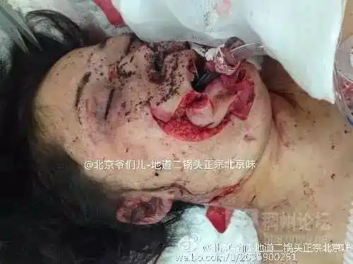 慎入>八达岭被老虎袭击当事人惨状(多图,视频)