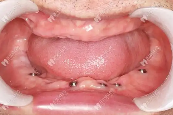 这些都是广州暨大穗华口腔荔湾院区的半全口种植牙病例