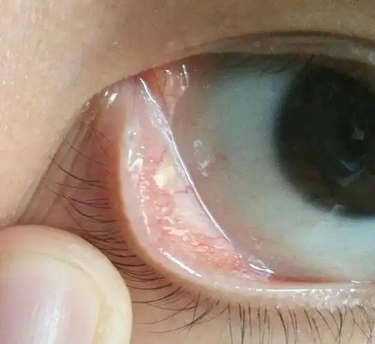 眼睑内有黄色小颗粒