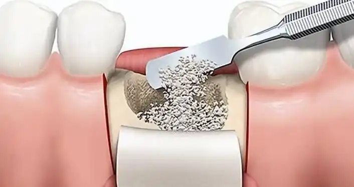 种植牙失败了怎么办?