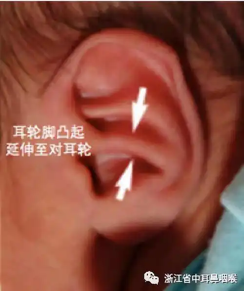 耳轮脚横凸耳轮自身折叠;耳廓上部呈幕状垂落,遮盖对耳轮上脚,致耳廓