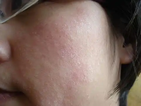 脸上皮肤发红的地方毛孔粗大,不断掉皮屑,微痒,请问这是什么皮肤病