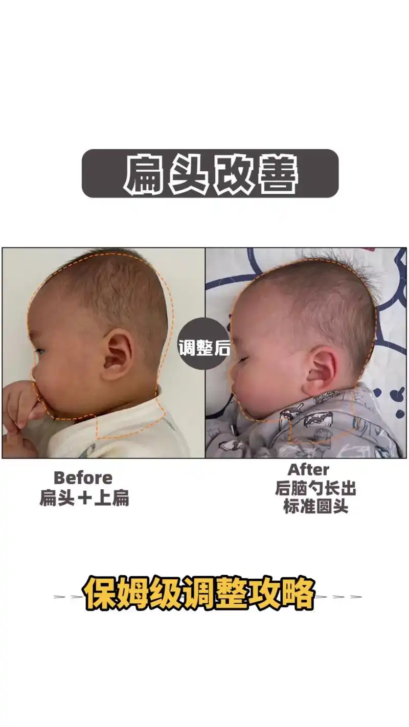 扁头宝宝2个月改善过程.想要宝宝有个小圆头,宝宝睡姿真的很重 - 抖音