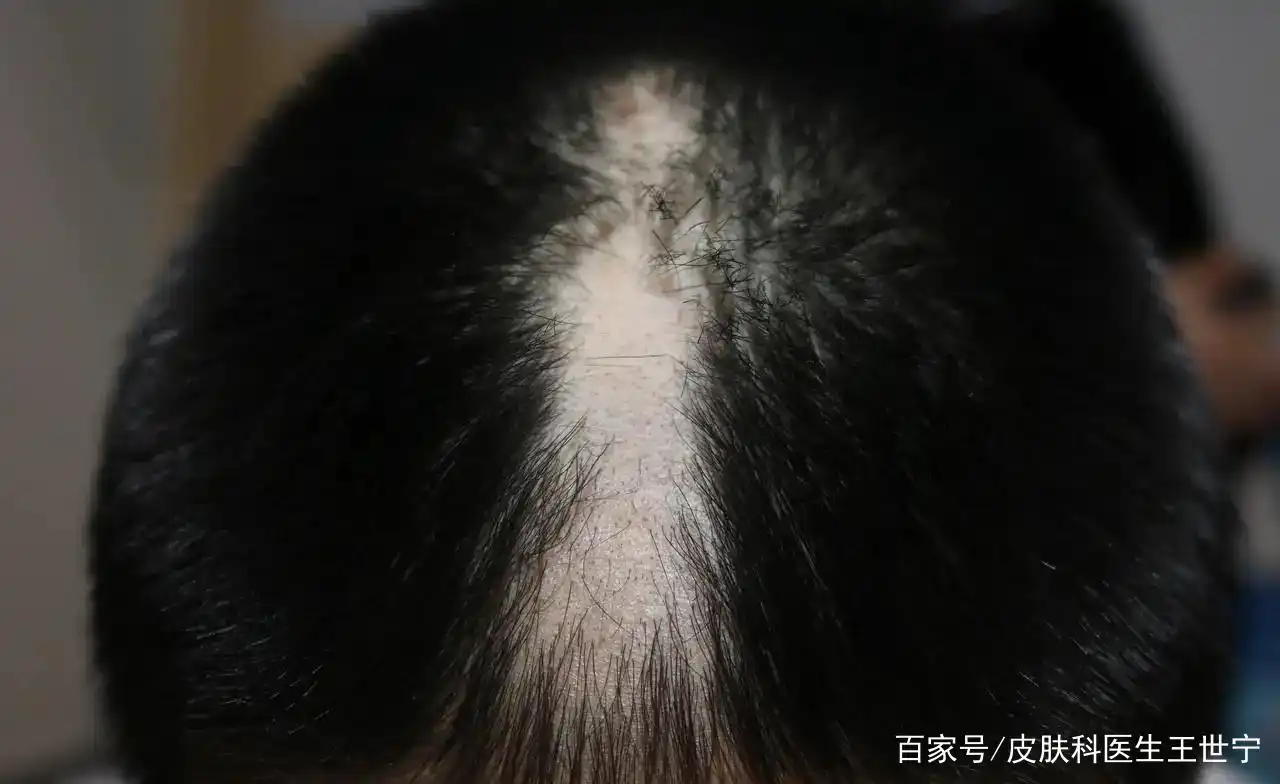 精神压力大导致的拔毛癖!