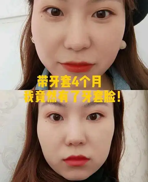 带牙套4个月,我竟然出现了牙套脸!
