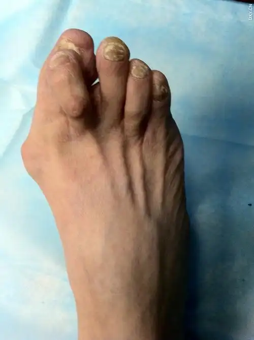 患者67岁,女性,因右足拇外翻合并第二趾锤状指畸形10年,目前严重影响