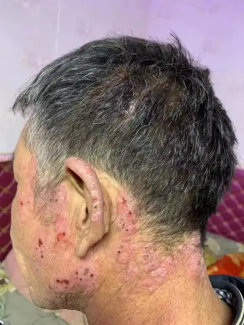 《关于慢性日光性皮炎》 - 皮肤病