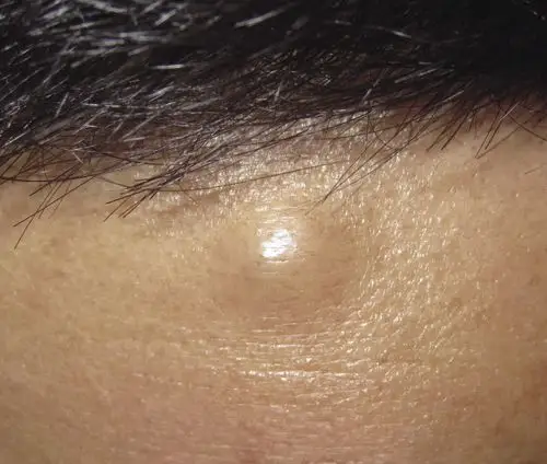 皮肤性病科图谱: 皮肤肿瘤 表皮囊肿