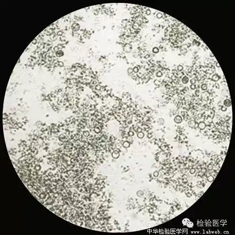 非晶性尿酸盐↑胆红素结晶↑胆固醇结晶↑草酸钙结晶以下发布常见的