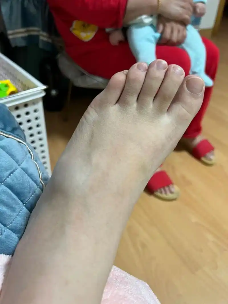 踢到石头,脚鼓包 走路玩手机的后果,鞋子又薄又软,踢到石头,感觉脚面