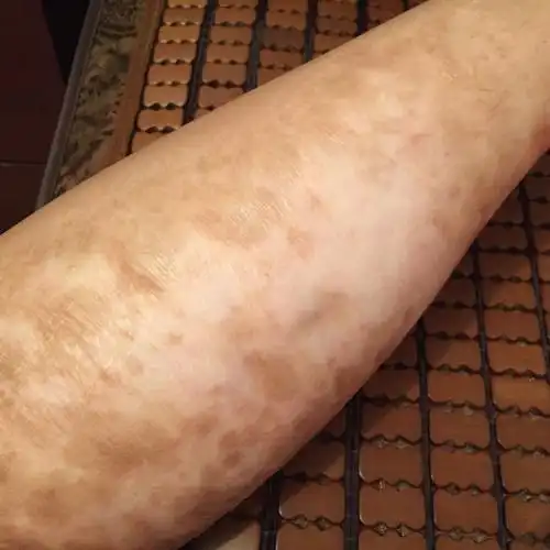 十七八年的烫伤疤该怎么治疗,一般的祛疤产品能去除吗?还是应该整形?