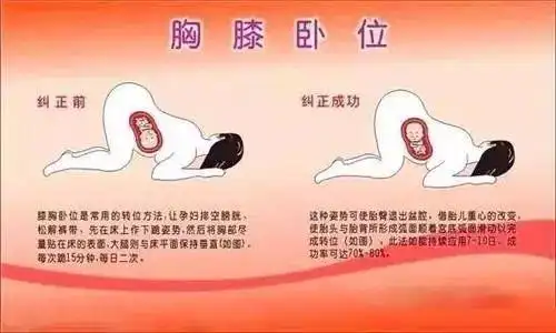 "涨姿势"胎位不正是怎样的?纠正胎位看这里._胎儿