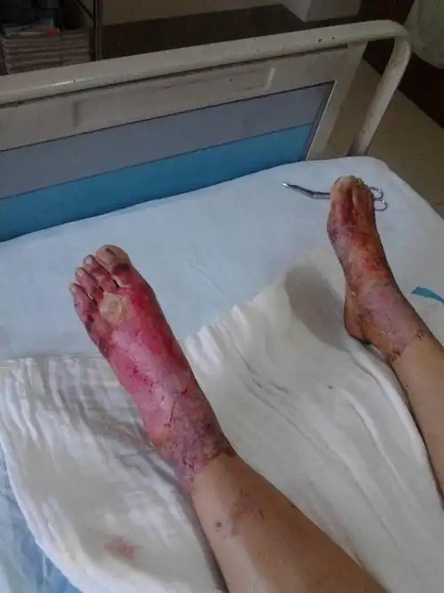 二级烫伤后恢复的图片_有来医生