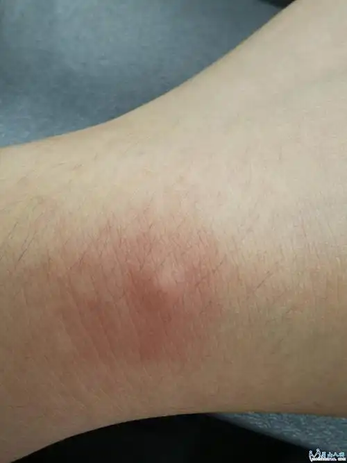 中午在公司睡觉被蚊子咬了,鼓这么大个包,这蚊子淬毒了吗?