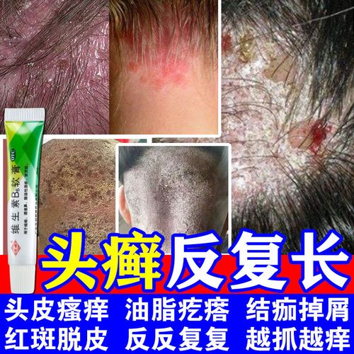 治头癣真菌感染头皮屑瘙痒专用药膏头皮痒脂溢性皮炎毛囊炎头部专用药