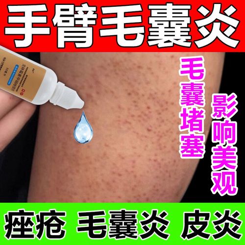 克林霉素甲硝唑搽剂治毛囊炎特效药 手臂后背祛痘 毛囊炎 长痘痘胳膊