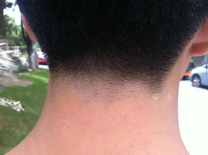 白斑初期如何治疗?