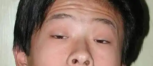 突然"大小眼"竟是肌无力_症状_肢体_接头