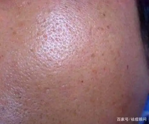 肌肤杀手 毛孔粗大