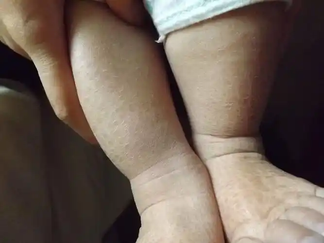 皮肤缺少什么导致的 急急急!