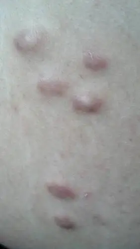 身上长了一些肉疙瘩,看着像水痘,摸着硬硬的,不疼也不痒,一年多了都没