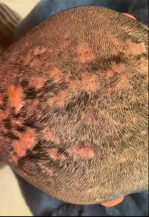 一种奇怪的毛囊炎——穿掘性毛囊炎