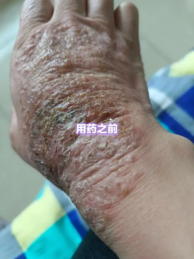 疱疹性皮肤病在拉萨三个月买不到药就成这样了还好家里的药管用几天