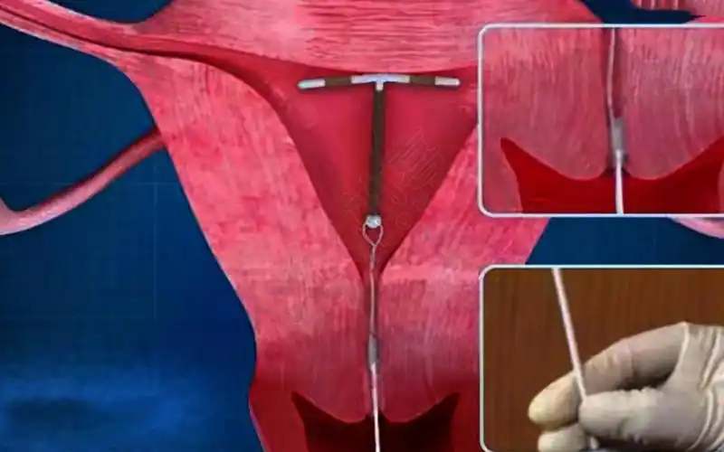 女人上环副作用大避孕环的5大坏处不可忽视