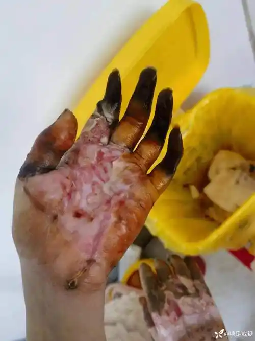 这种烫伤你见过吗