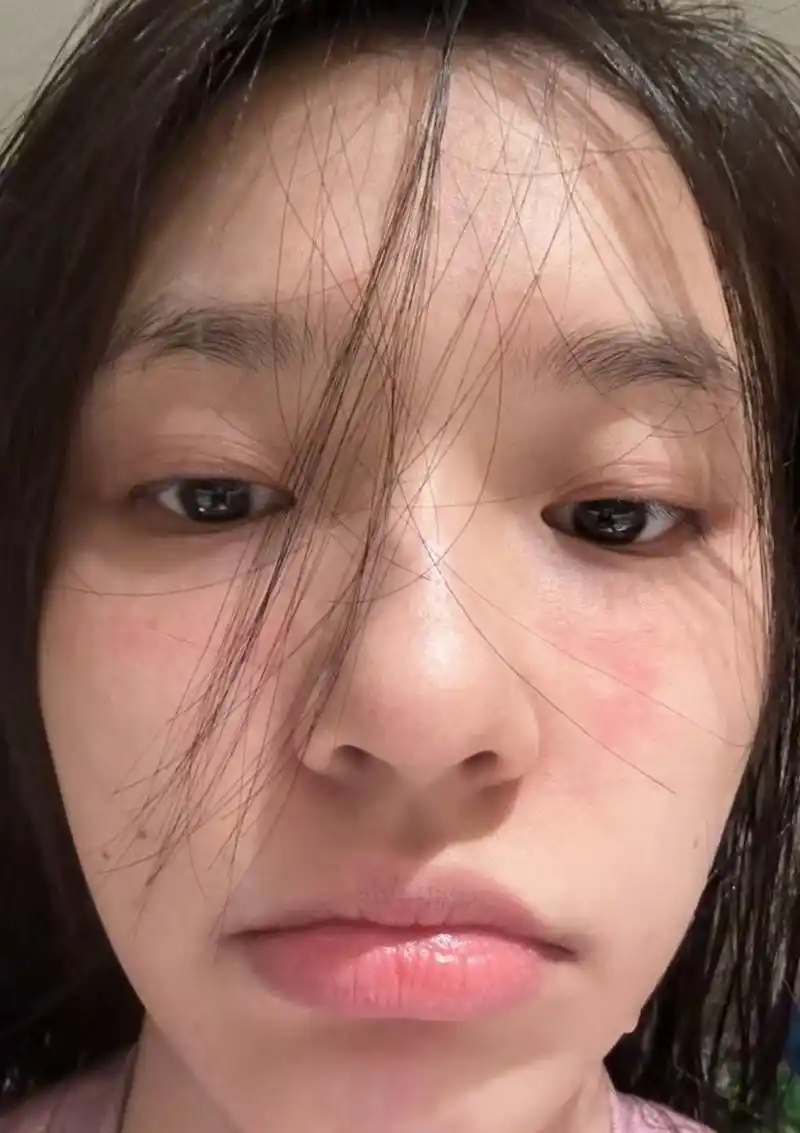 林允素颜在家吃饭,一个人点五个菜胃口不小,她脸上过敏起了很多红点点