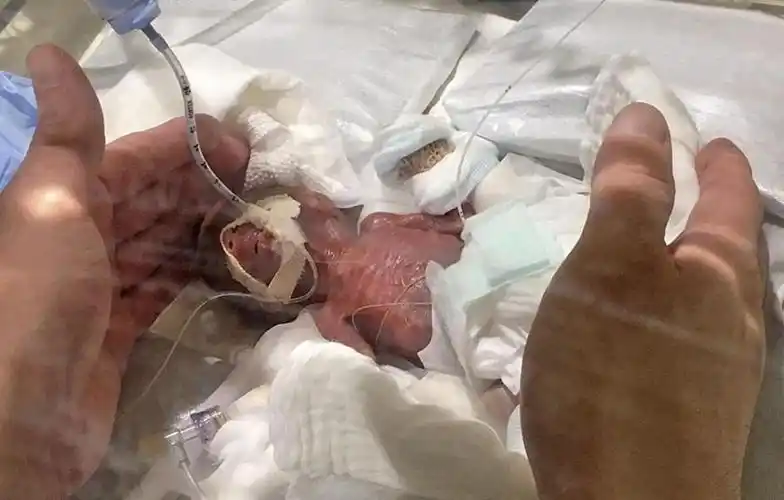 世界最小男婴平安出院出生时体重仅为268克的他成功增重出院