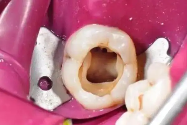 牙虫是真的虫吗