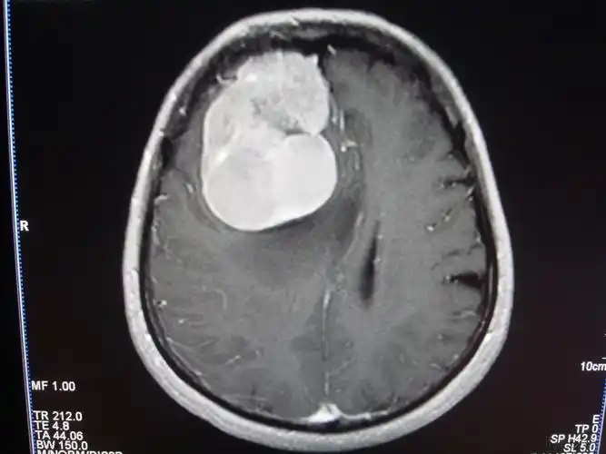 如果遇到这些情况要赶紧去做脑部ct检查避免延误问题