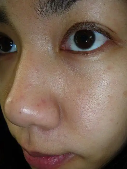 脸部皮肤粗糙的原因(多半跟6个原因有关系)