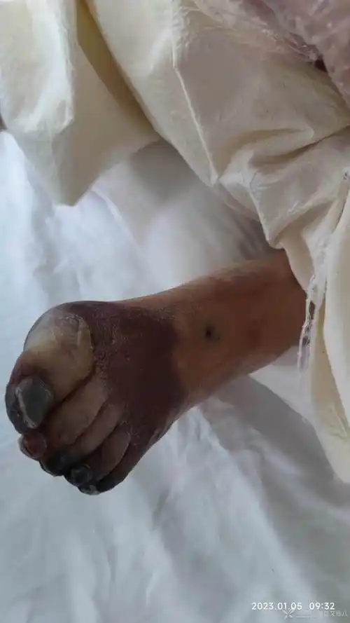 动脉栓塞导致的坏疽