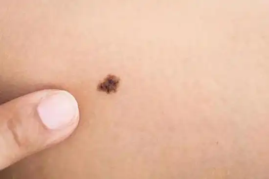 为什么痣上会长毛为啥痣上会长毛