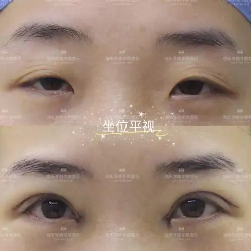上脸下垂减龄幼态眼术后即刻对比