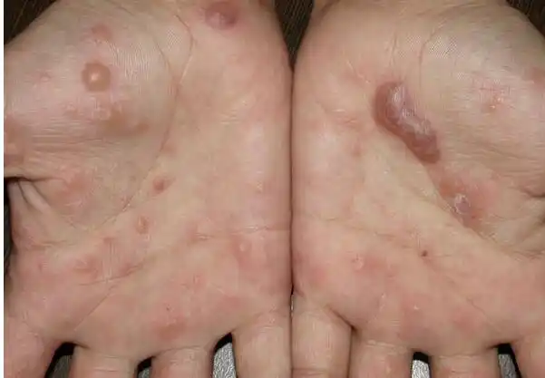 疥疮的初期症状图片 (44)