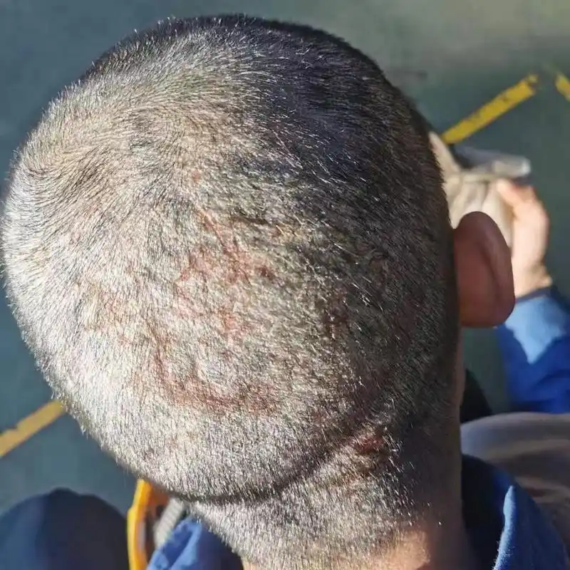 头部牛皮癣 银屑病