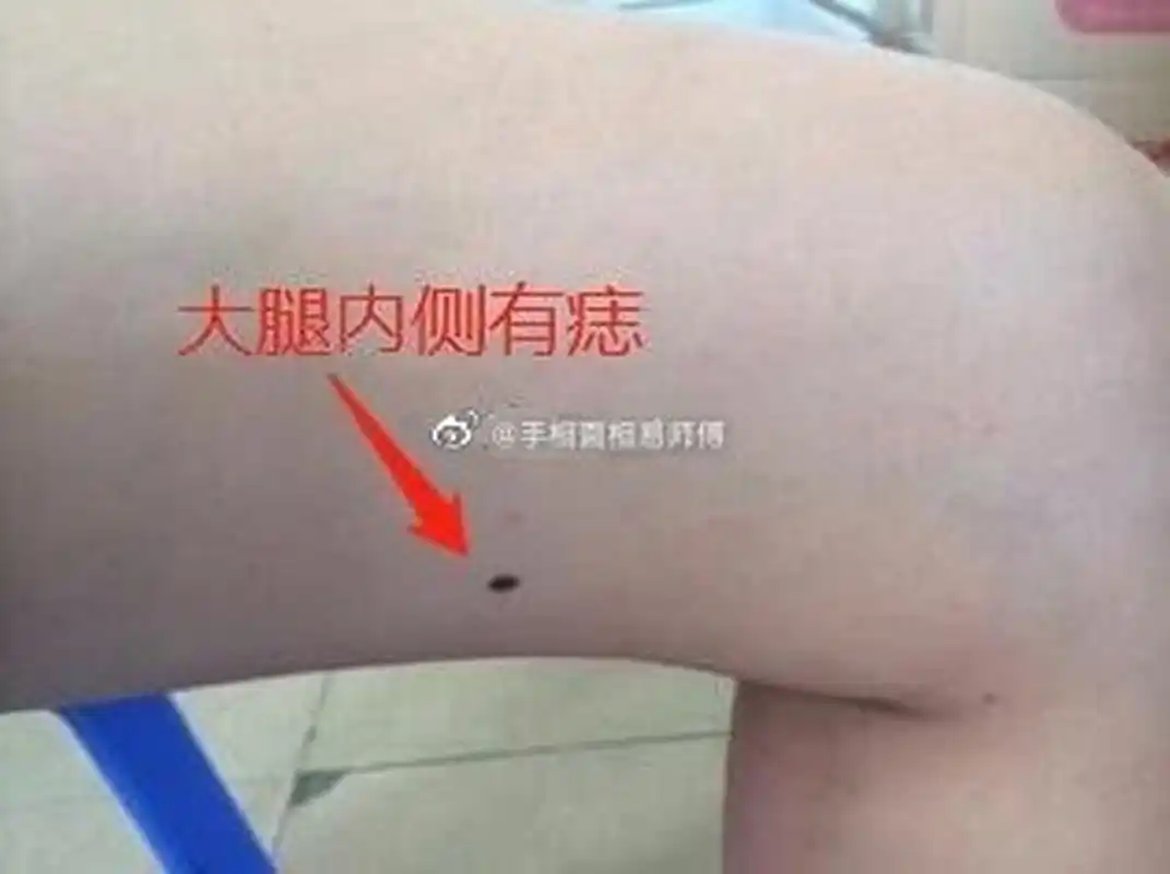 左腿内侧长痣的女人性格外向活泼,右侧长痣的成熟冷静,但是不论左右