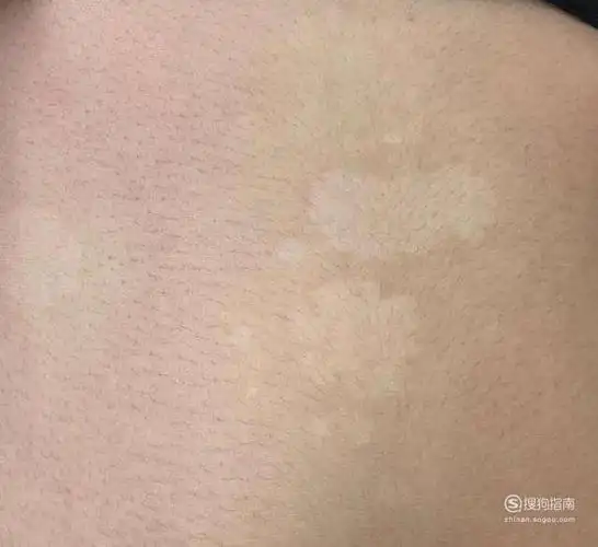 白斑初期症状是什么样的