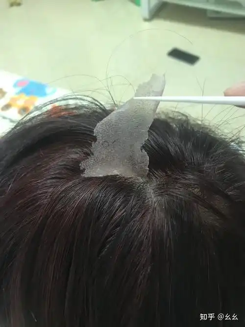 见过的最大头皮屑多大