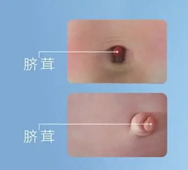 新生儿肚脐茸肚脐芽该怎么办?如何让宝宝的伤害降低到最小?