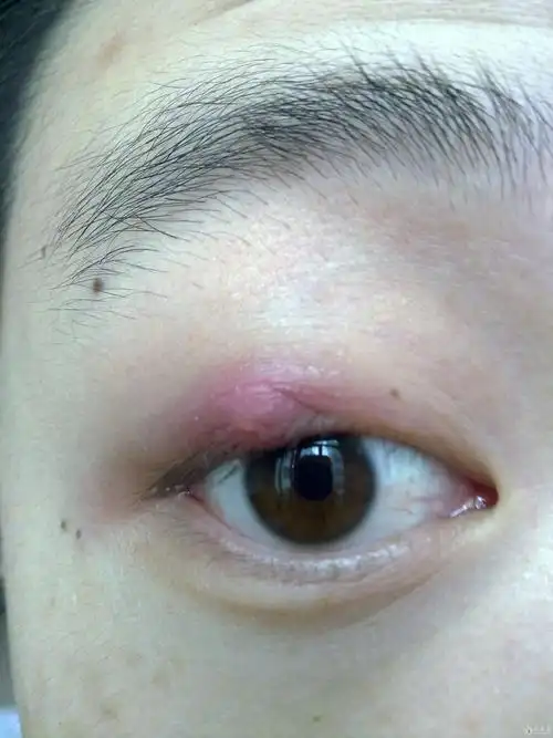 霰粒肿求证该如何处理