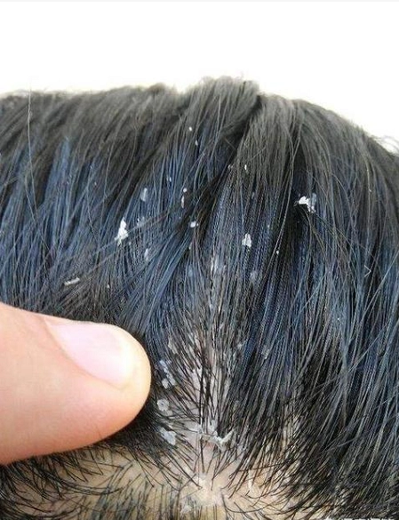 痒头皮屑的原因